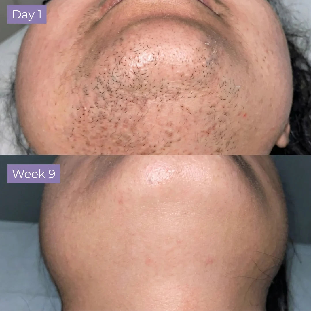 Evolène™ - Anti-Hair Growth Serum
